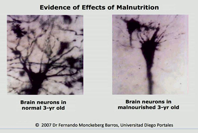 Evidence of Effects of Malnutrition.png