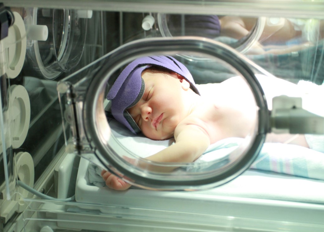 jaundiced baby in hospital